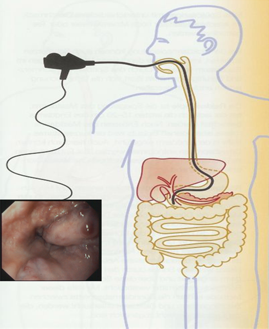 Esophagogastroduodenoscopy