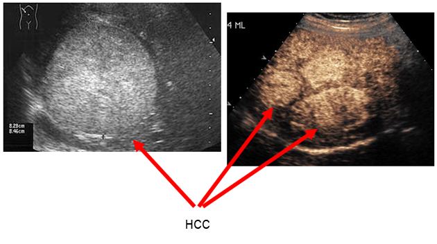 liver cancer ultrasound