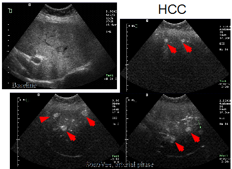 Bir kontrast maddesi verildikten sonra karaciğerde sonografik olarak bir çok küçük HCC ler (kırmızı oklar) görünmekte