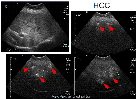 Early hepatocellular cancer